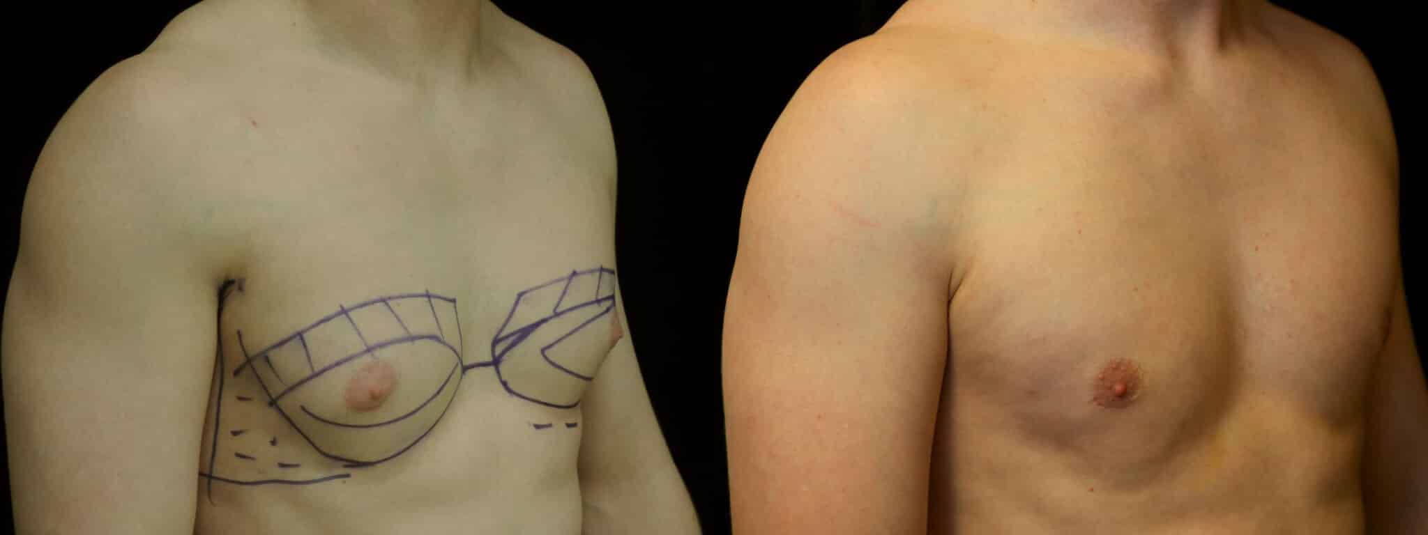 Gynecomastia Patient 2 Before & After Details