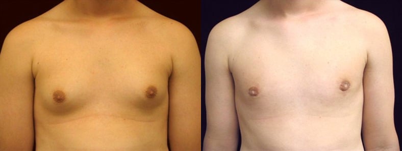 Gynecomastia Patient 19 Before & After