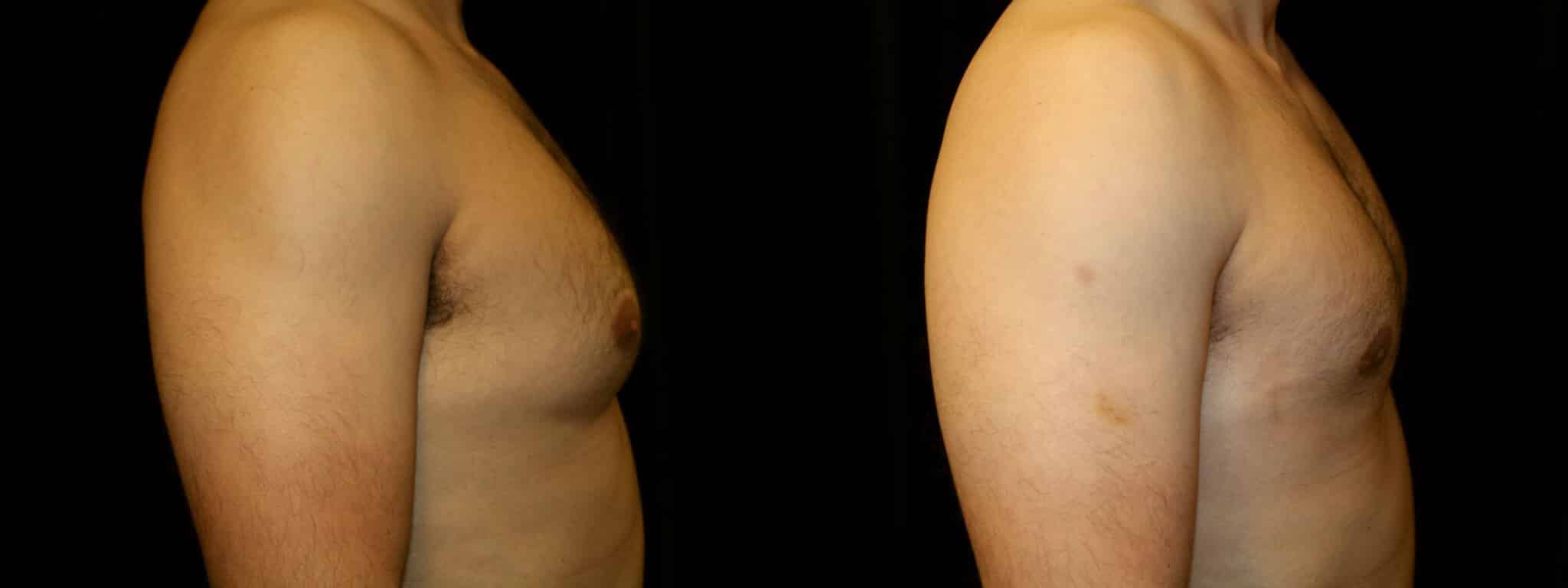 Gynecomastia Patient 14 Before & After Details