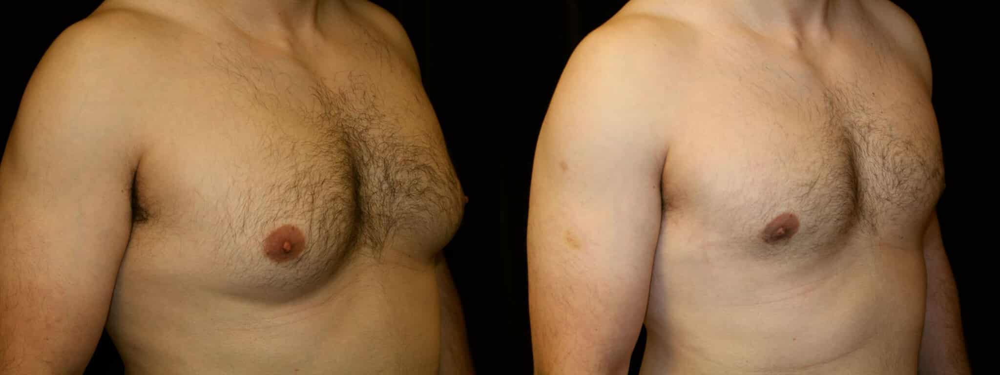 Gynecomastia Patient 14 Before & After Details