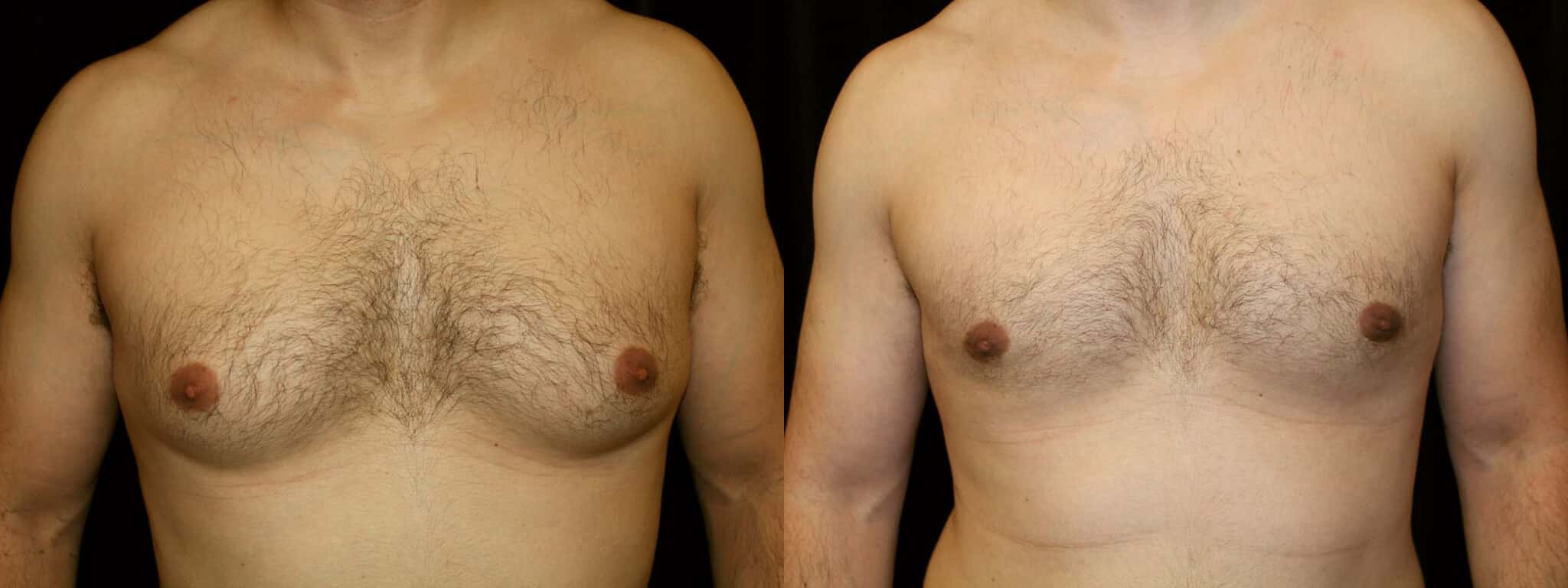 Gynecomastia Patient 14 Before & After