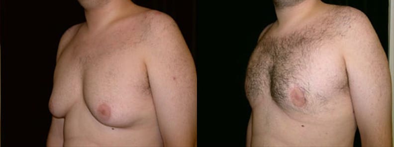 Gynecomastia Patient 9 Before & After Details