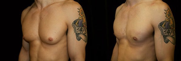 Gynecomastia Patient 17 Before & After Details