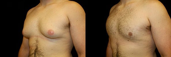 Gynecomastia Patient 20 Before & After Details