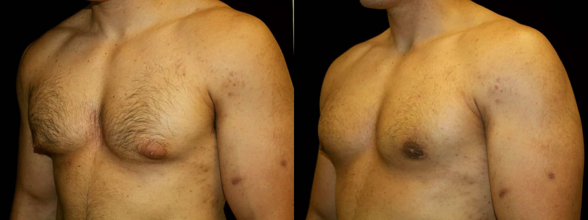 Gynecomastia Patient 21 Before & After Details