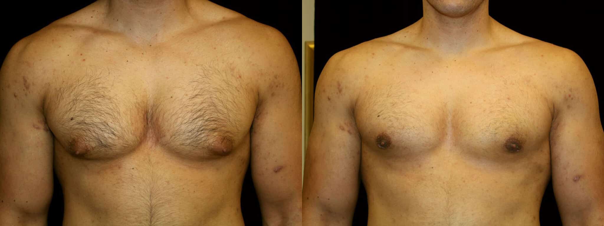 Gynecomastia Patient 21 Before & After