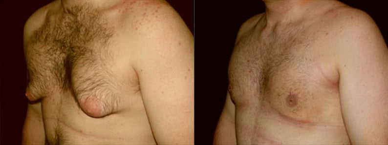 Gynecomastia Patient 14 Before & After Details