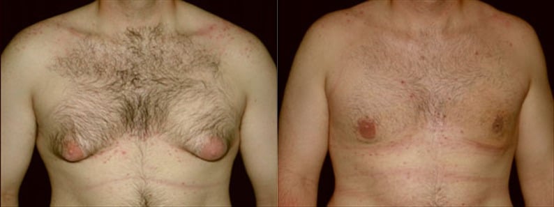 Gynecomastia Patient 14 Before & After