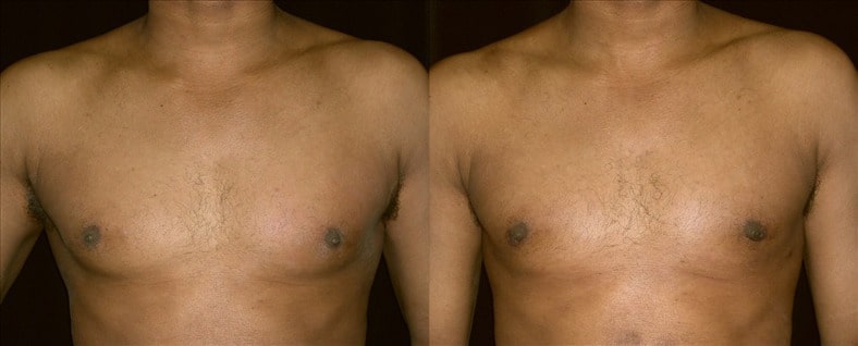 Gynecomastia Patient 19 Before & After