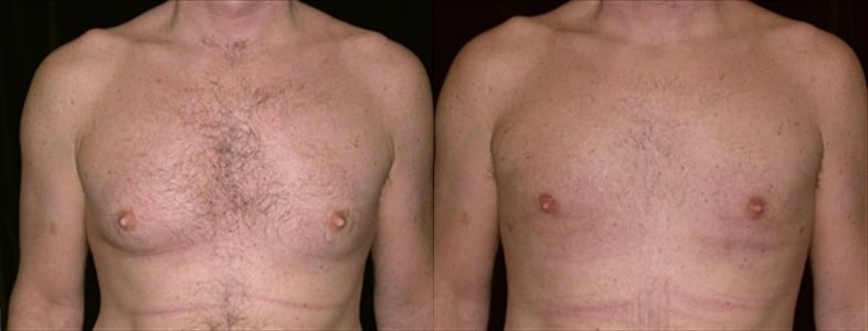 Gynecomastia Patient 1 Before & After