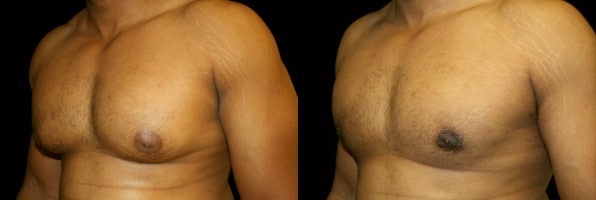 Gynecomastia Patient 3 Before & After Details