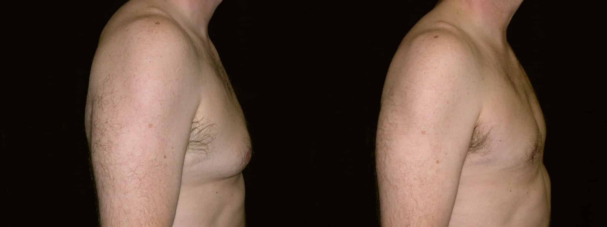 Gynecomastia Patient 16 Before & After Details