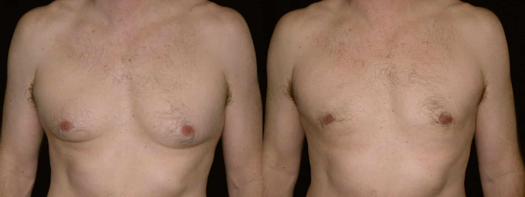 Gynecomastia Patient 16 Before & After