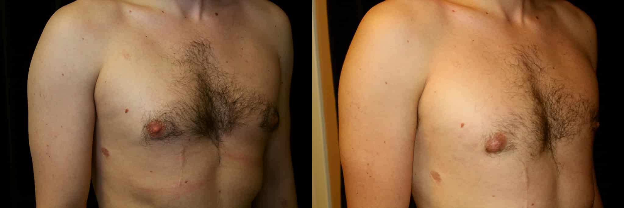 Gynecomastia Patient 16 Before & After Details