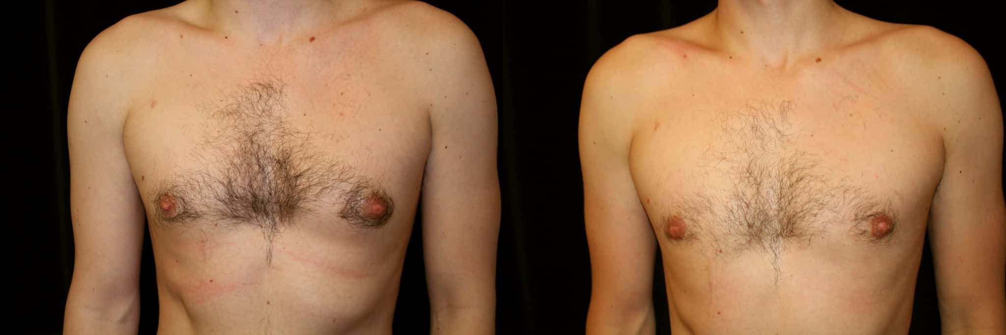 Gynecomastia Patient 16 Before & After