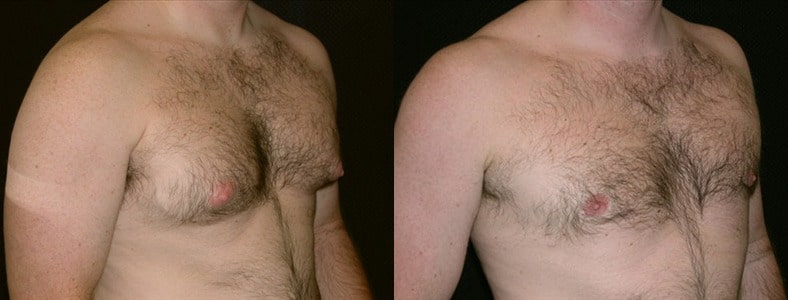 Gynecomastia Patient 3 Before & After