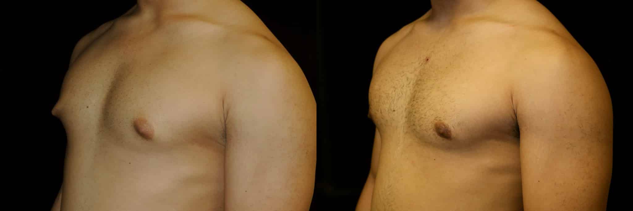 Gynecomastia Patient 12 Before & After Details