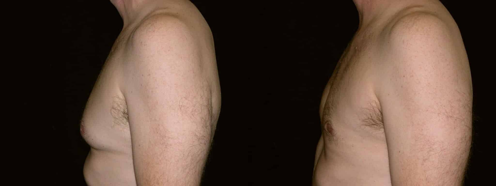 Gynecomastia Patient 16 Before & After Details