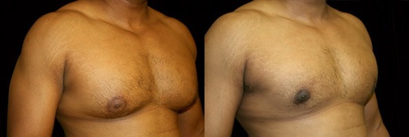 Gynecomastia Patient 3 Before & After Details