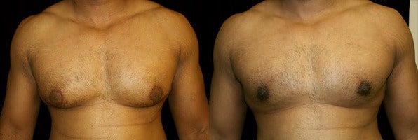 Gynecomastia Patient 3 Before & After