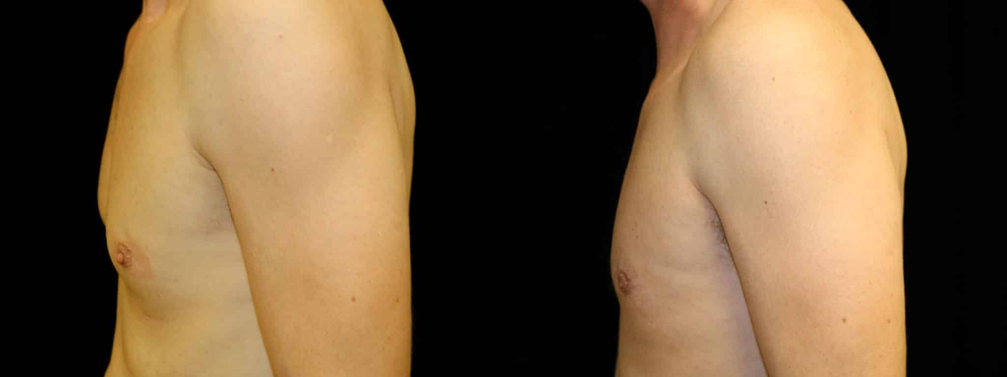 Gynecomastia Patient 19 Before & After Details