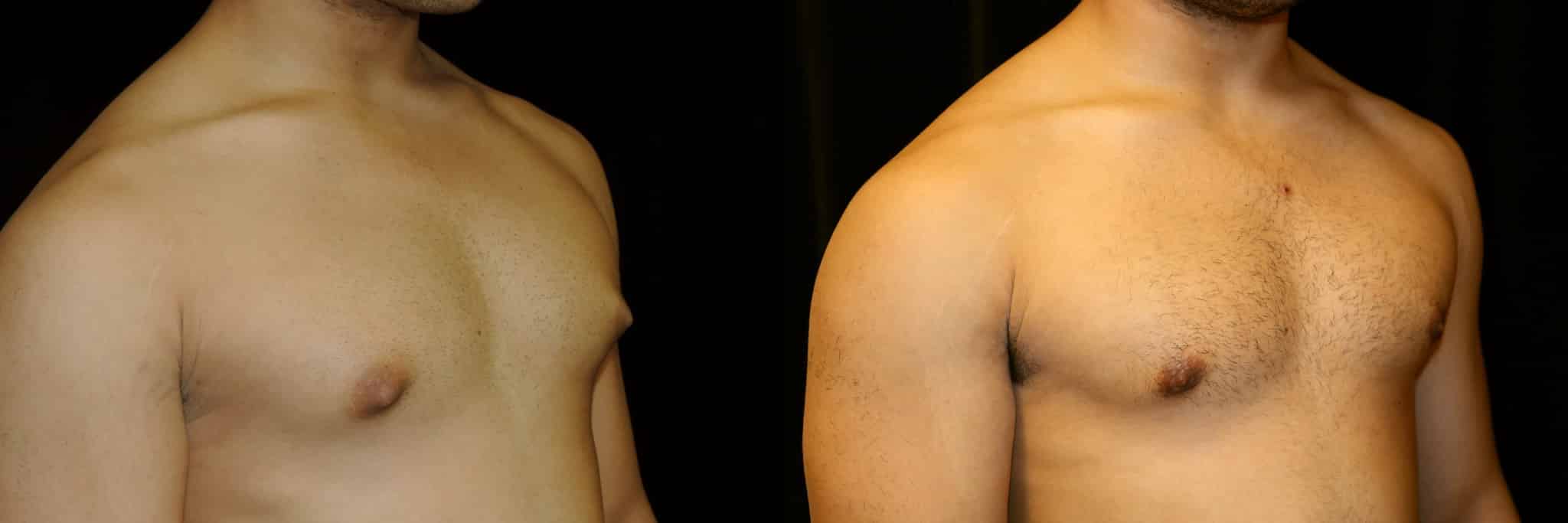 Gynecomastia Patient 12 Before & After Details