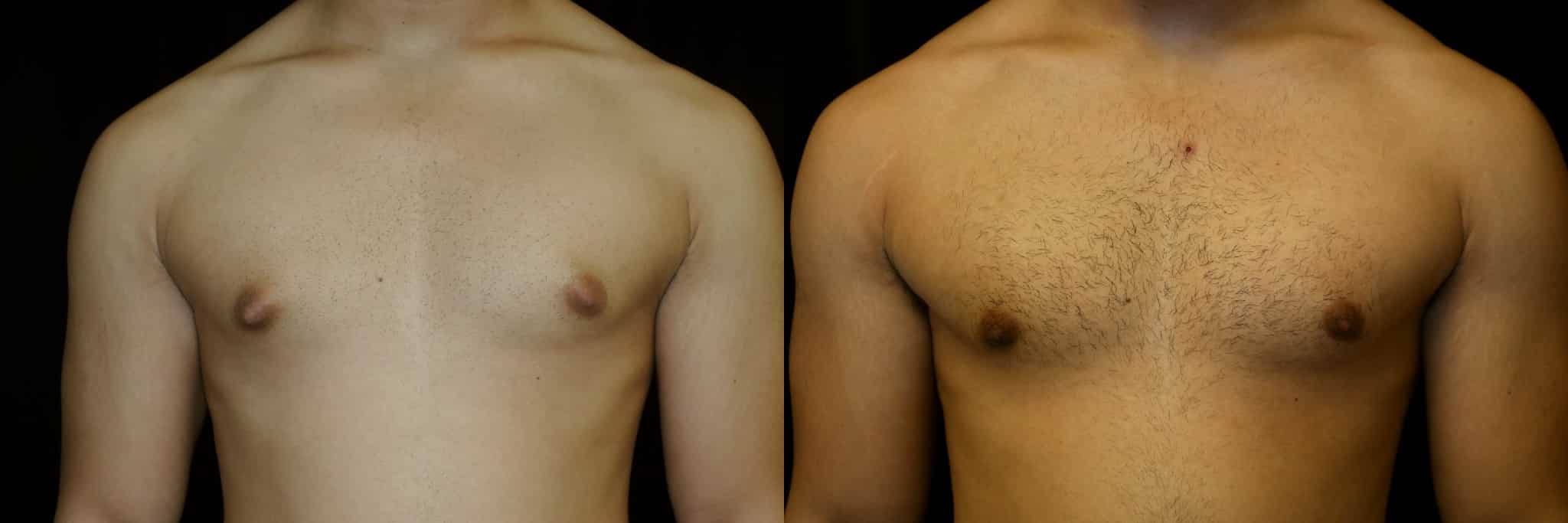 Gynecomastia Patient 12 Before & After