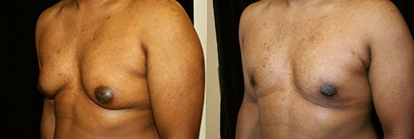 Gynecomastia Patient 2 Before & After Details