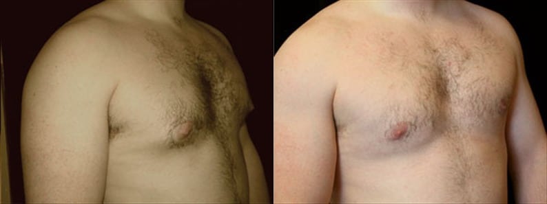 Gynecomastia Patient 16 Before & After Details