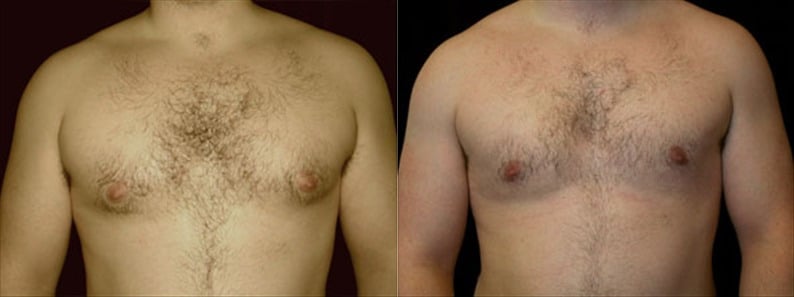 Gynecomastia Patient 16 Before & After