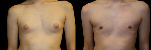 Gynecomastia Patient 3 Before & After