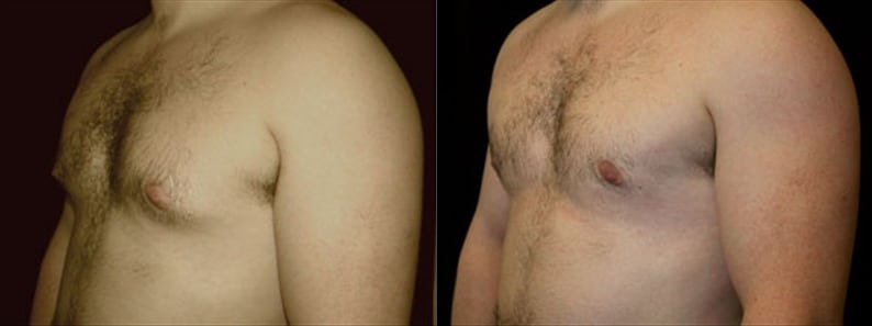 Gynecomastia Patient 16 Before & After Details