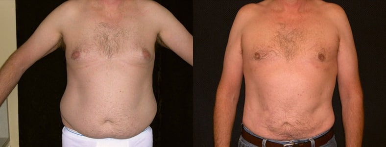 Before and after of gynecomastia surgery and liposuction of the abdomen and flanks.