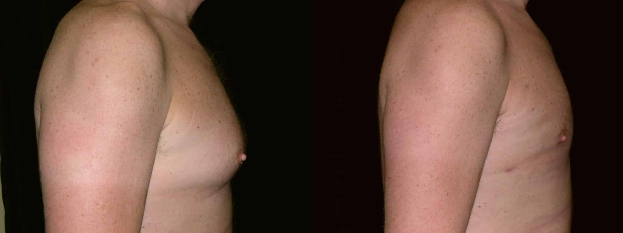 Gynecomastia Patient 8 Before & After Details