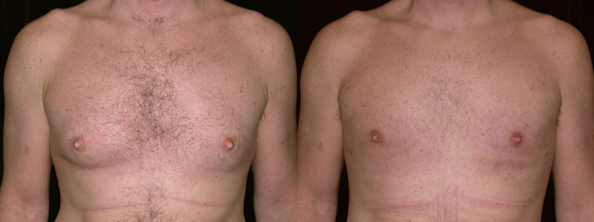 Gynecomastia Patient 8 Before & After