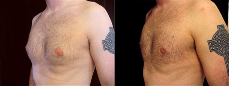 Gynecomastia Patient 10 Before & After Details