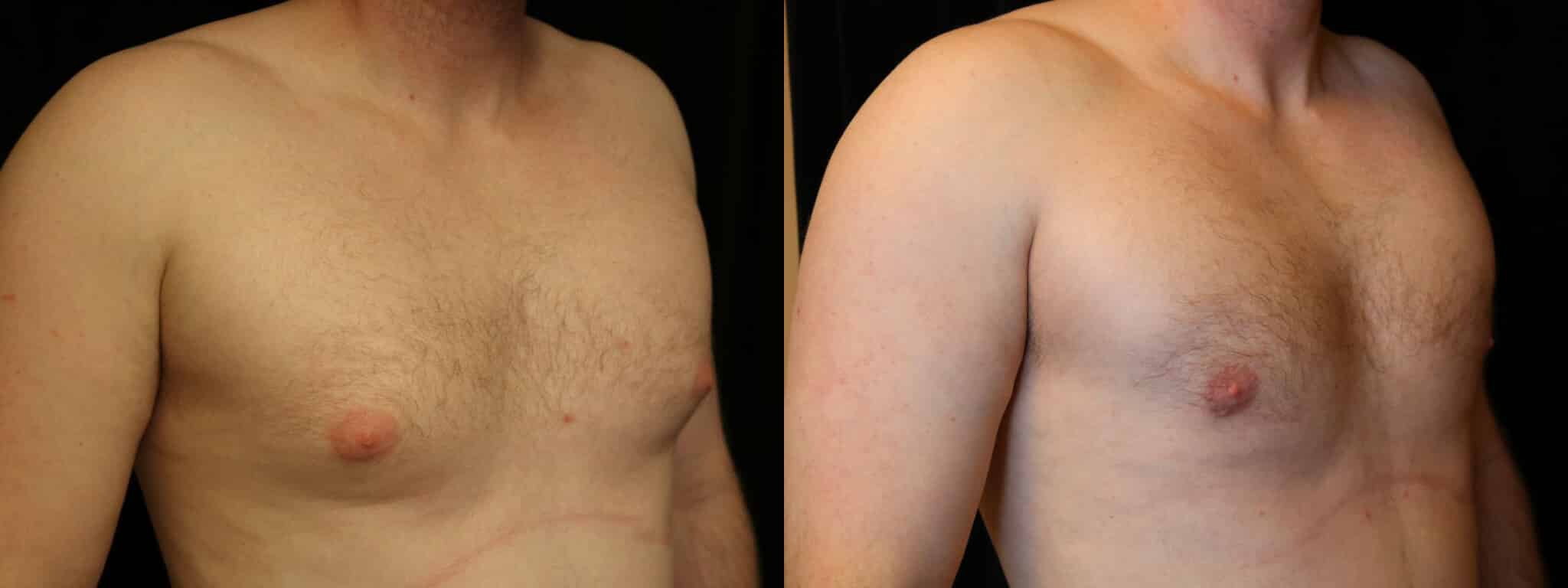 Gynecomastia Patient 18 Before & After Details