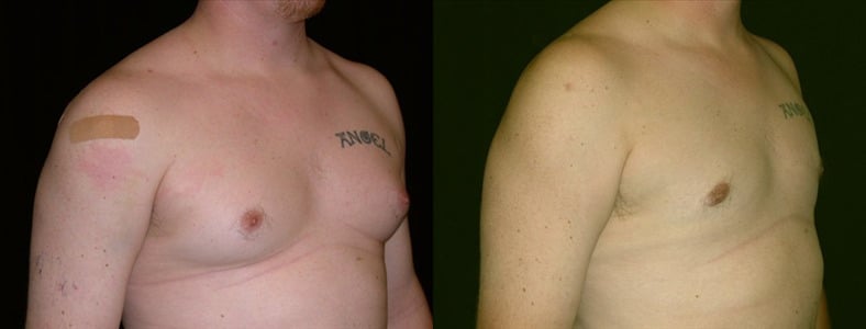 Gynecomastia Patient 5 Before & After