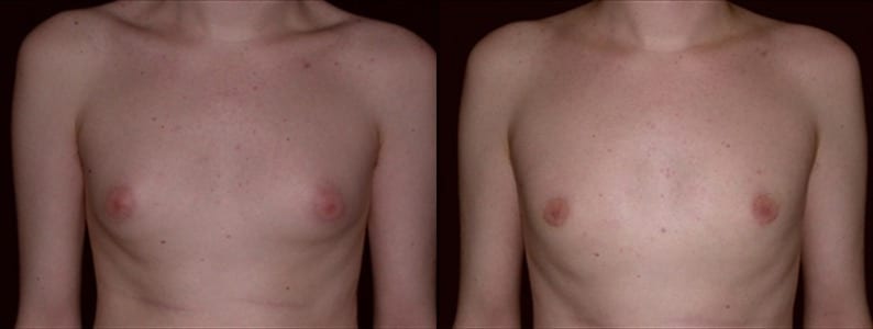 Gynecomastia Patient 3 Before & After