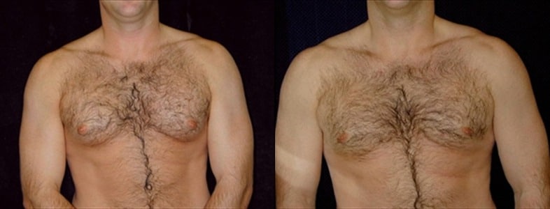 Gynecomastia Patient 19 Before & After