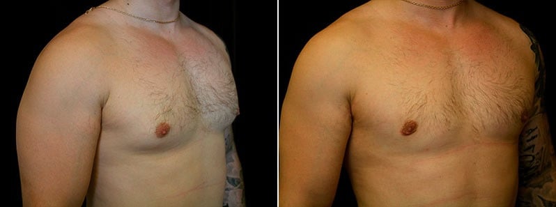 Gynecomastia Patient 5 Before & After Details