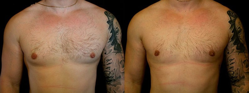 Gynecomastia Patient 5 Before & After