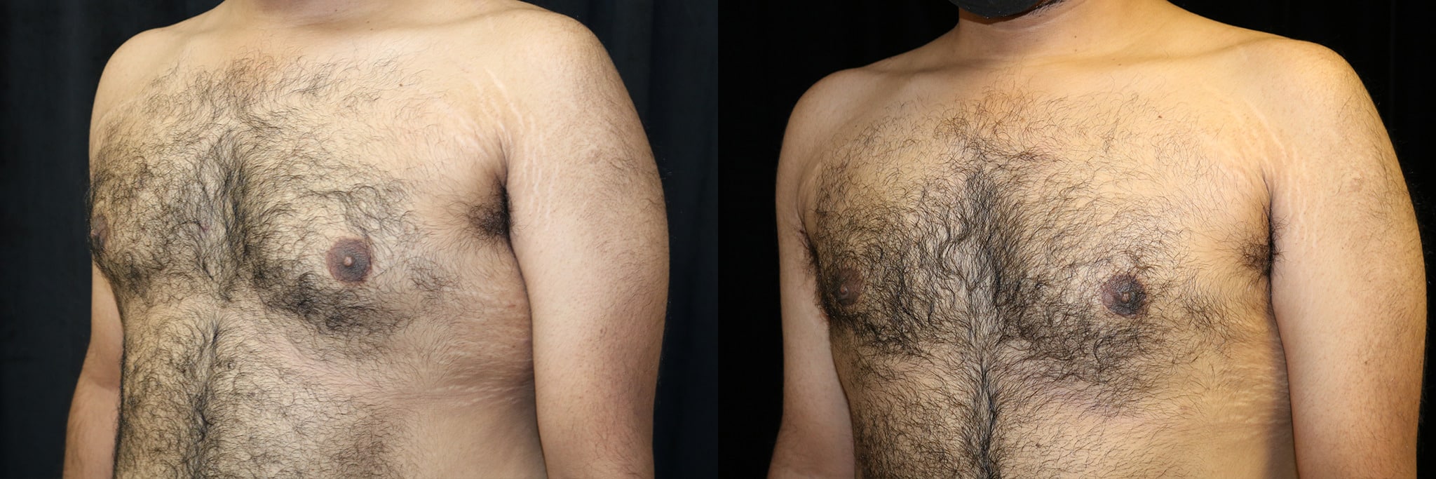 Gynecomastia Patient 19 Before & After Details