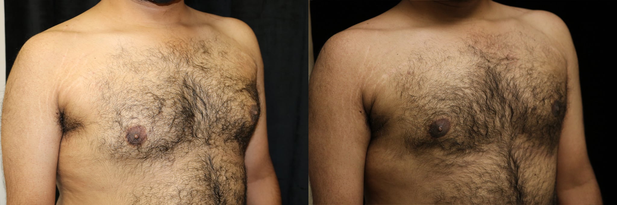 Gynecomastia Patient 19 Before & After Details