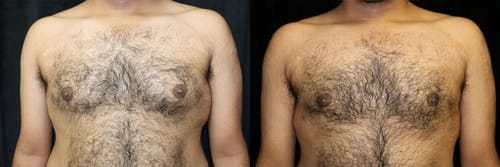 Gynecomastia Patient 19 Before & After