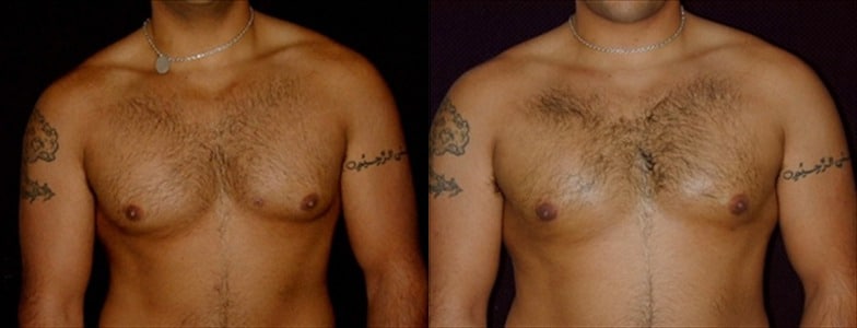 Gynecomastia Patient 6 Before & After