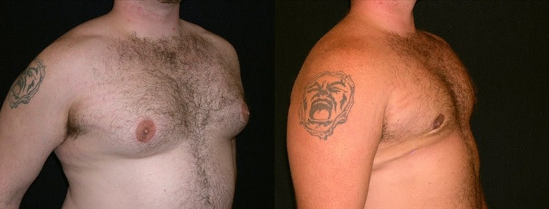 Gynecomastia Patient 6 Before & After