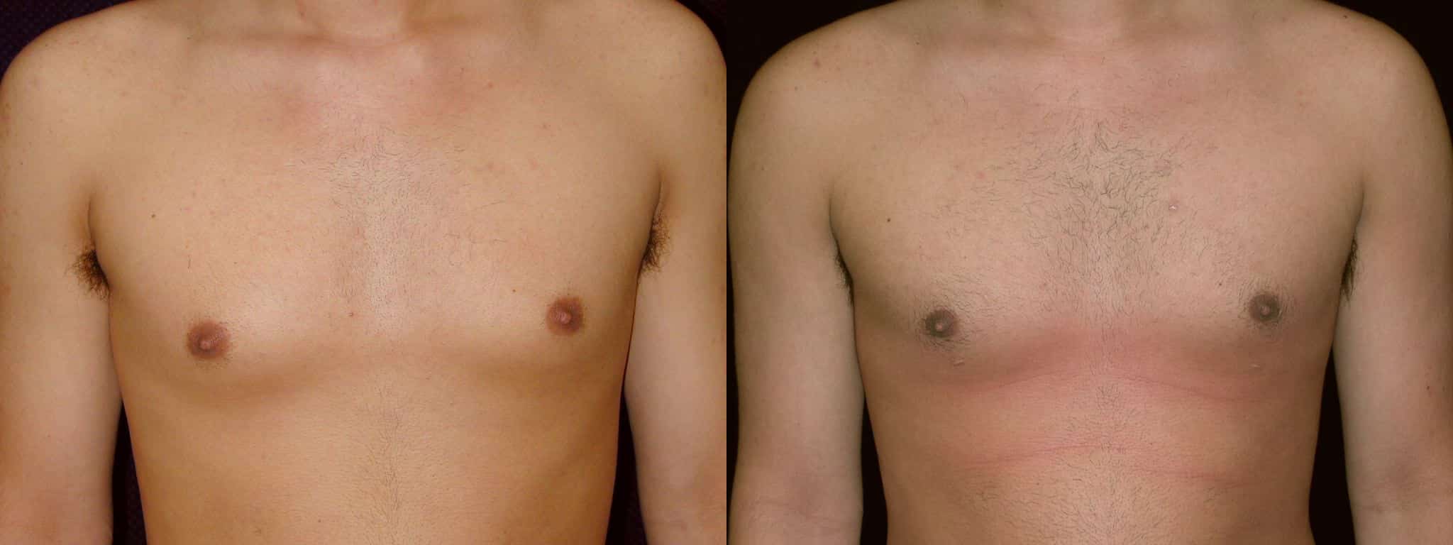 Gynecomastia Patient 12 Before & After