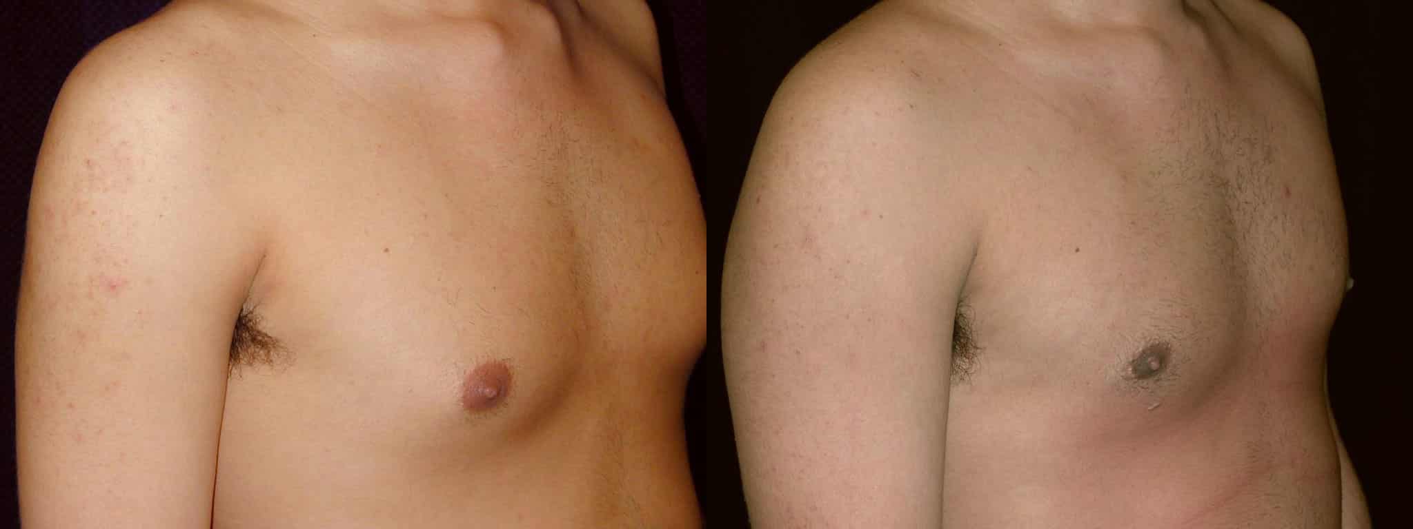 Gynecomastia Patient 12 Before & After Details