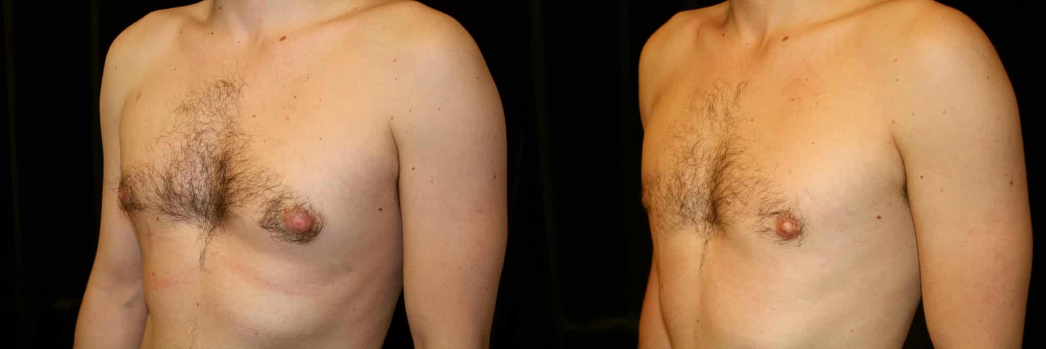 Gynecomastia Patient 16 Before & After Details